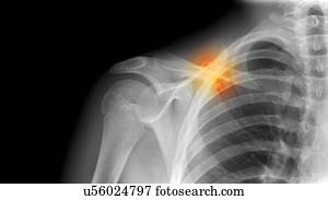 broken collarbone x ray