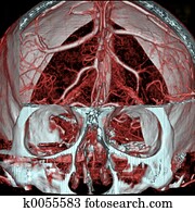 MRI/MRA of Brain MRI/MRA of Brain