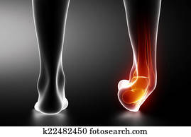 הקעה, קרסול, שחור, רנטגן