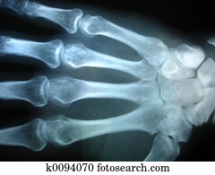 raio x mão