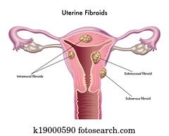 uterino, fibroids