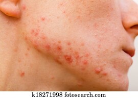 Acne skin Acne skin
