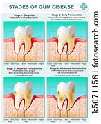 ביים, של, מסטיק, מחלה
