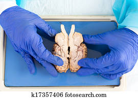 autopsy female section brain pathologist holding cross mortem medical fotosearch