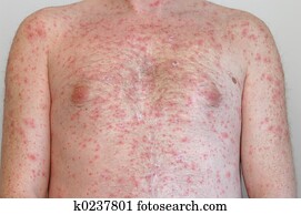 Chicken pox Chicken pox