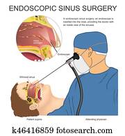 Endoscopic sinus surgery. Endoscopic sinus surgery.