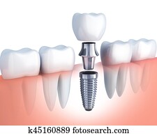 row tooth and Dental implant row tooth and Dental implant