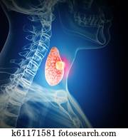 thyroid cance thyroid cance
