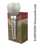 dental, implante