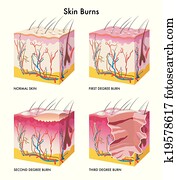 Skin Burns Skin Burns