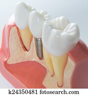 Dental implant Dental implant
