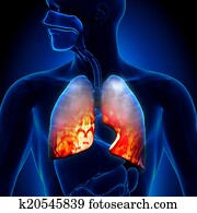 Pneumonia, -, pulmões, inflamatório, Cond