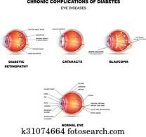 Diabetic Eye Diseases