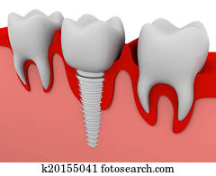 Dental implant Dental implant