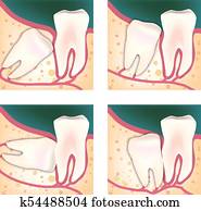 Root canal Root canal