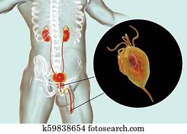 trichomoniasis infection man illustration fotosearch prostatitis drawing