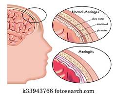 Meningitis Meningitis