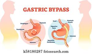 Gastric bypass medical surgery procedure vector illustration with esophagus, stomach, duodenum and jejunum flow. Gastric bypass medical surgery procedure vector illustration with esophagus, stomach, duodenum and jejunum flow.