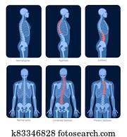 עמוד שדרה, *x* קרן