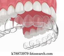 3d, render, של, עליון, לסת, עם, invisalign, ניתן להסרה, שכר טרחה