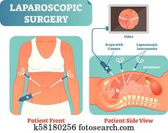 Laparoscopic surgery medical health care surgical procedure process, anatomical cross section vector illustration diagram. Laparoscopic surgery medical health care surgical procedure process, anatomical cross section vector illustration diagram.