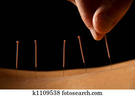 Acupuncture Acupuncture