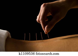 Acupuncture Acupuncture