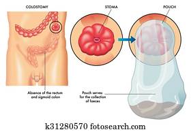 colostomy colostomy