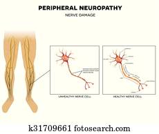 neuropathy,, nerv, schaden neuropathy,, nerv, schaden