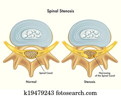 של השדרה, היצרות