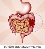 colon cancer colon cancer