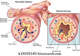 ברונכיאלי, קצרת