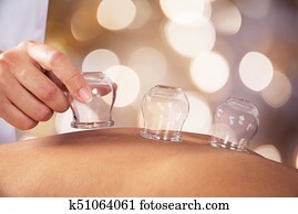 Person Giving Cupping Treatment Person Giving Cupping Treatment