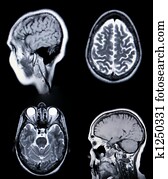 High Resolution  MRI/ MRA (Magnetic Resonance Angiogram) of the brain vasculature (arteries) CRT Monitor Grain Visible