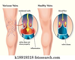 varicose, veias