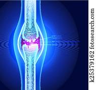 הזק, מפרק, illustration,, תקציר, *x* קרן, עצב