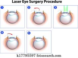 Laser Eye Surgery Procedure Laser Eye Surgery Procedure