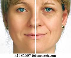 Correction of wrinkles - half face Correction of wrinkles - half face