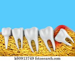 molars and wisdom tooth molars and wisdom tooth