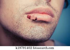 Man with nose bleed and cold sores Stock Image | k19788333 | Fotosearch