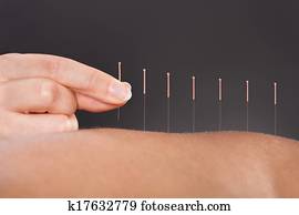 acupuntura, tratamento