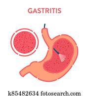 בטן, gastritis, detected, על ידי, endoscopy, פרוצדורה רפואית