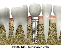 Dental implant Dental implant