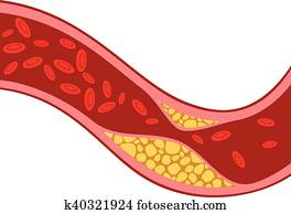 עורק, חסום, עם, כולסטרול
