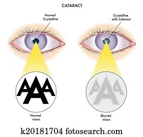 Cataract Cataract