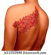 Shingles Disease Shingles Disease
