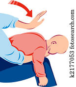 Infant heimlich maneuver Infant heimlich maneuver