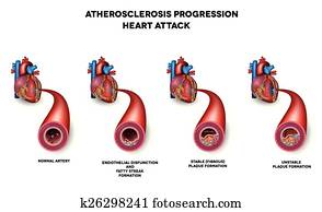 לב, attack,, עורק עורקי, מחלה