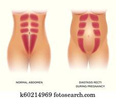 Diastasis Recti or abdominal separation Diastasis Recti or abdominal separation