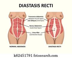 Diastasis recti. Abdominal muscle diastasis after pregnancy pregnancy and childbirth. Diastasis recti. Abdominal muscle diastasis after pregnancy pregnancy and childbirth.